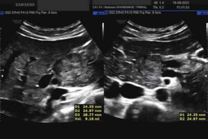 esami evidenziano eteroplasia