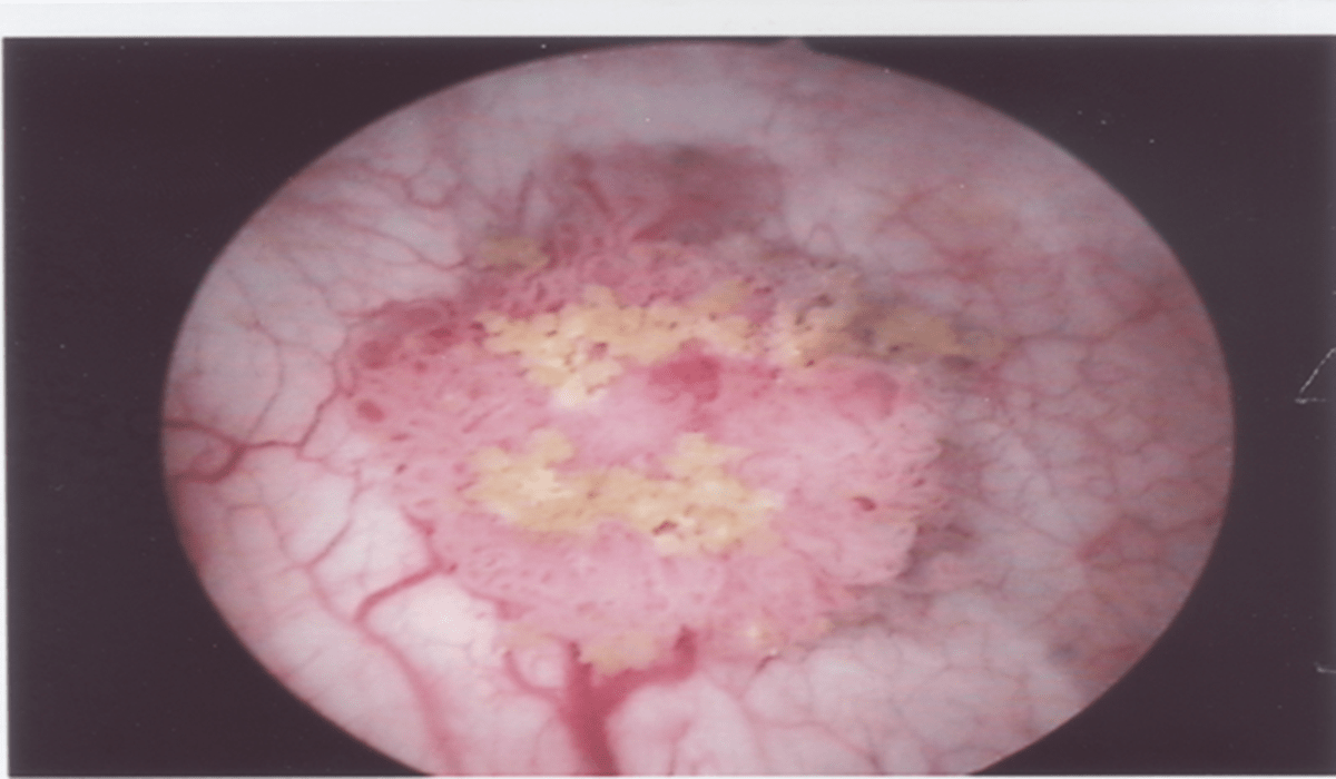 eteroplasia-2 eteroplasia