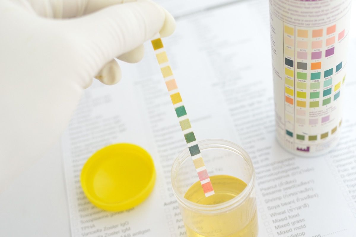 Emoglobina nelle urine