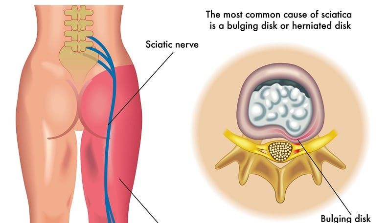 Sciatalgia 
