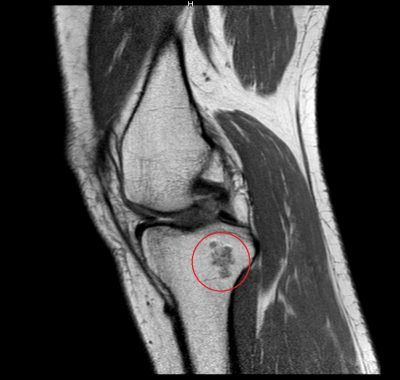 encondroma-condrosarcoma-ginocchio-400x380