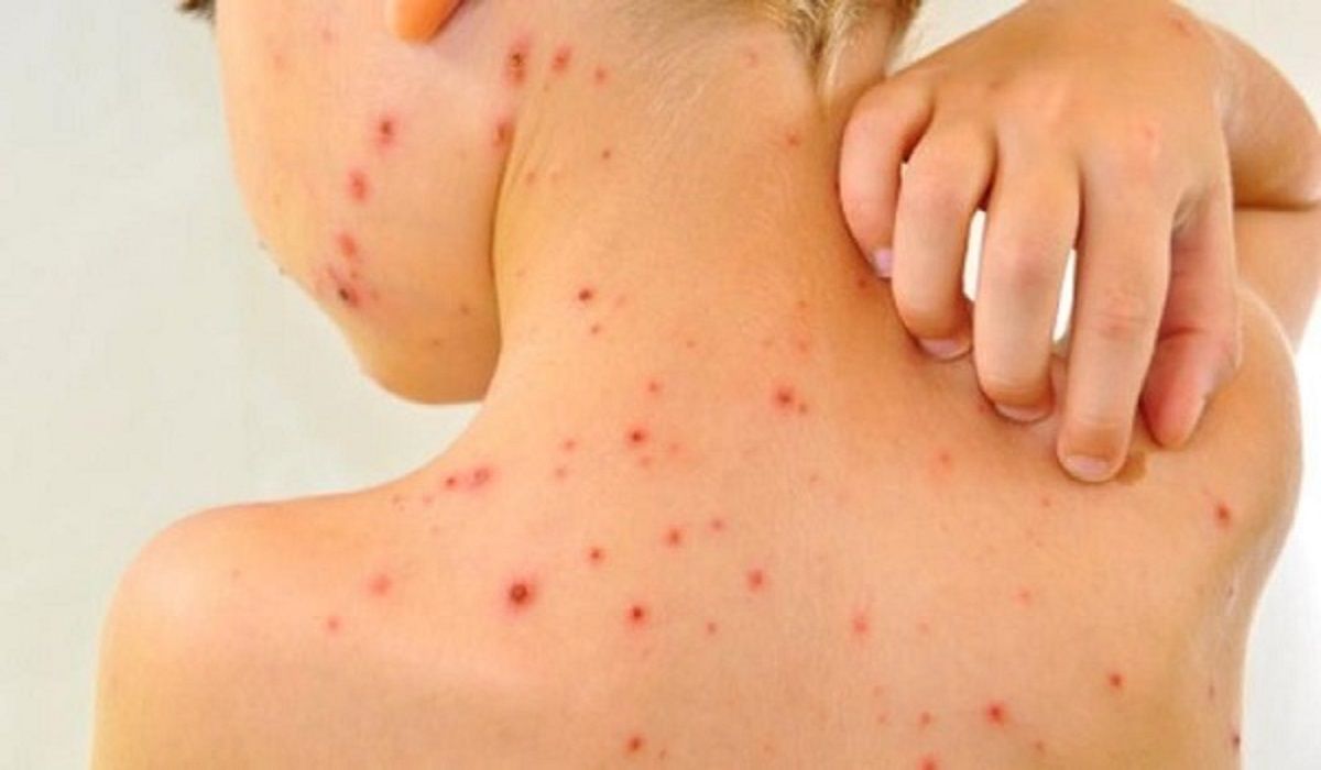 incubazione-varicella-2 incubazione varicella