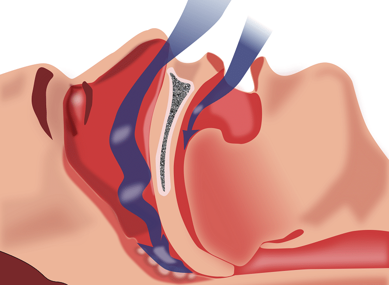 Apnea notturna