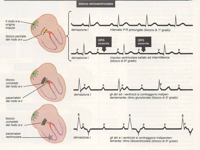 Blocco atrioventricolare Cause, fattori scatenanti e trattamento