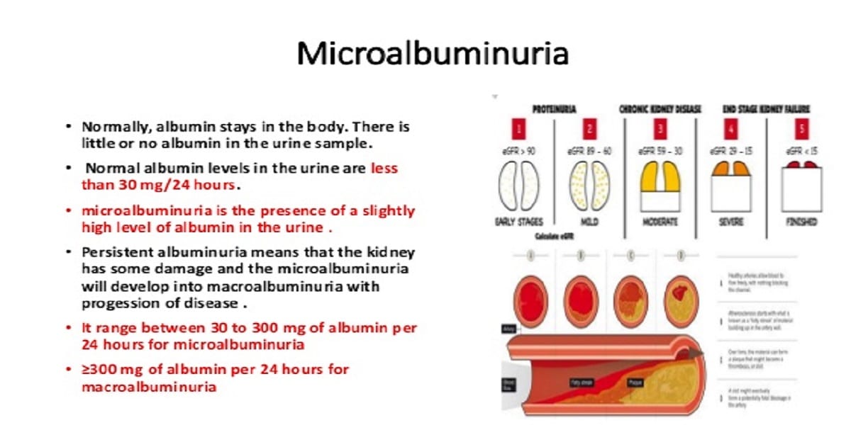 Microalbuminuria Microalbuminuria
