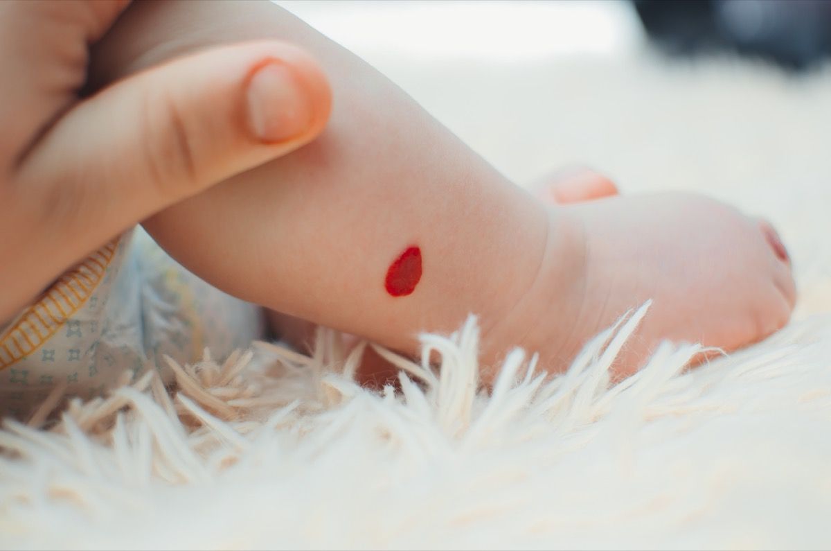 Angioma Neonato Unanomalia Vascolare Che è Possibile Curare