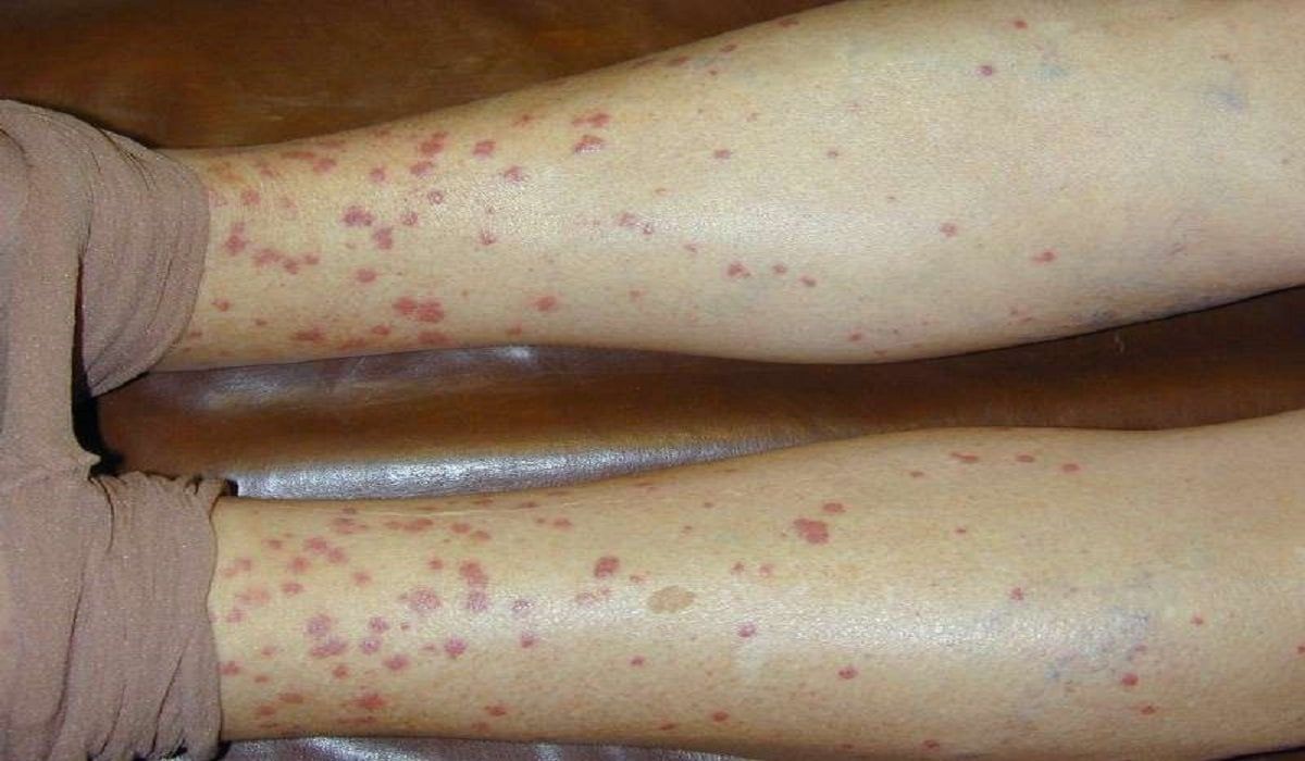 vasculite vasculite