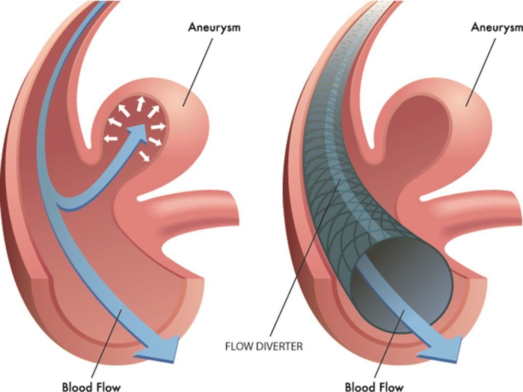 Aneurisma cerebrale: le cause