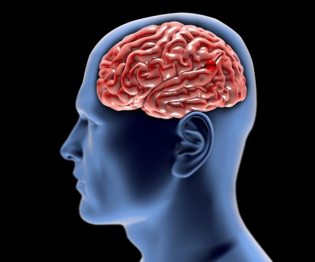 Aneurisma cerebrale: la diagnosi