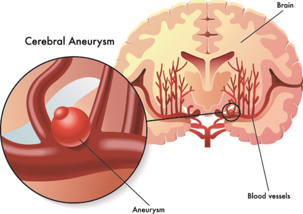 Aneurisma cerebrale: i sintomi