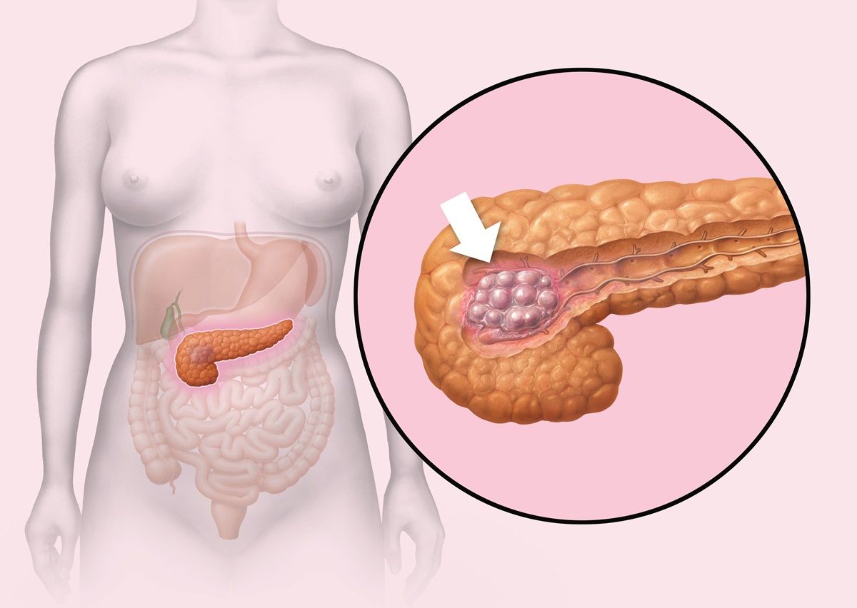 Nuovo test per la diagnosi-precoce del tumore al pancreas: tasso di mortalità