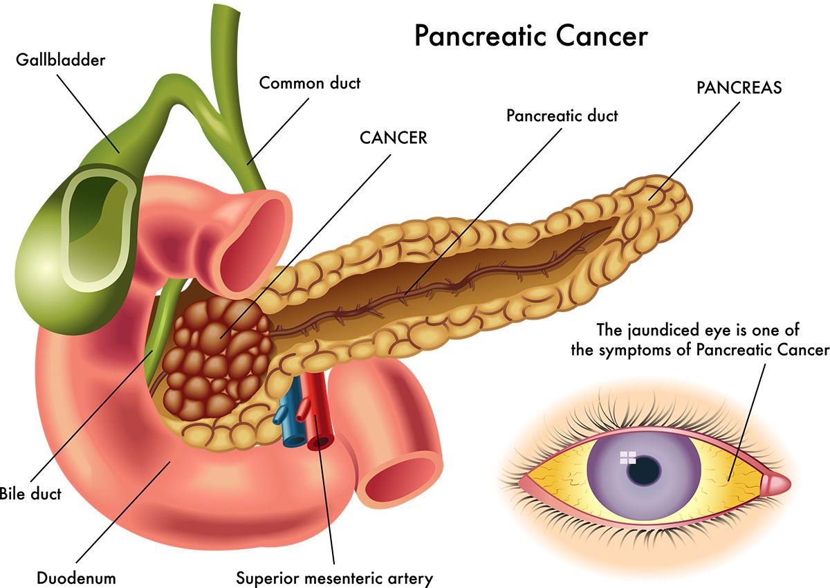 Nuovo test per la diagnosi-precoce del tumore al pancreas