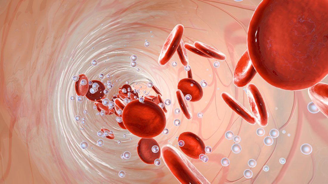 Cause della stenosi carotidea Cause della stenosi carotidea
