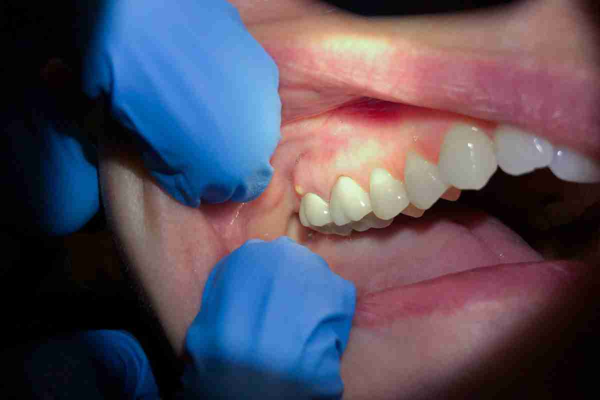 dentista controlla un ascesso
