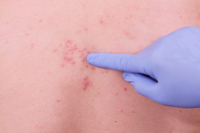 Herpes Zoster Herpes Zoster