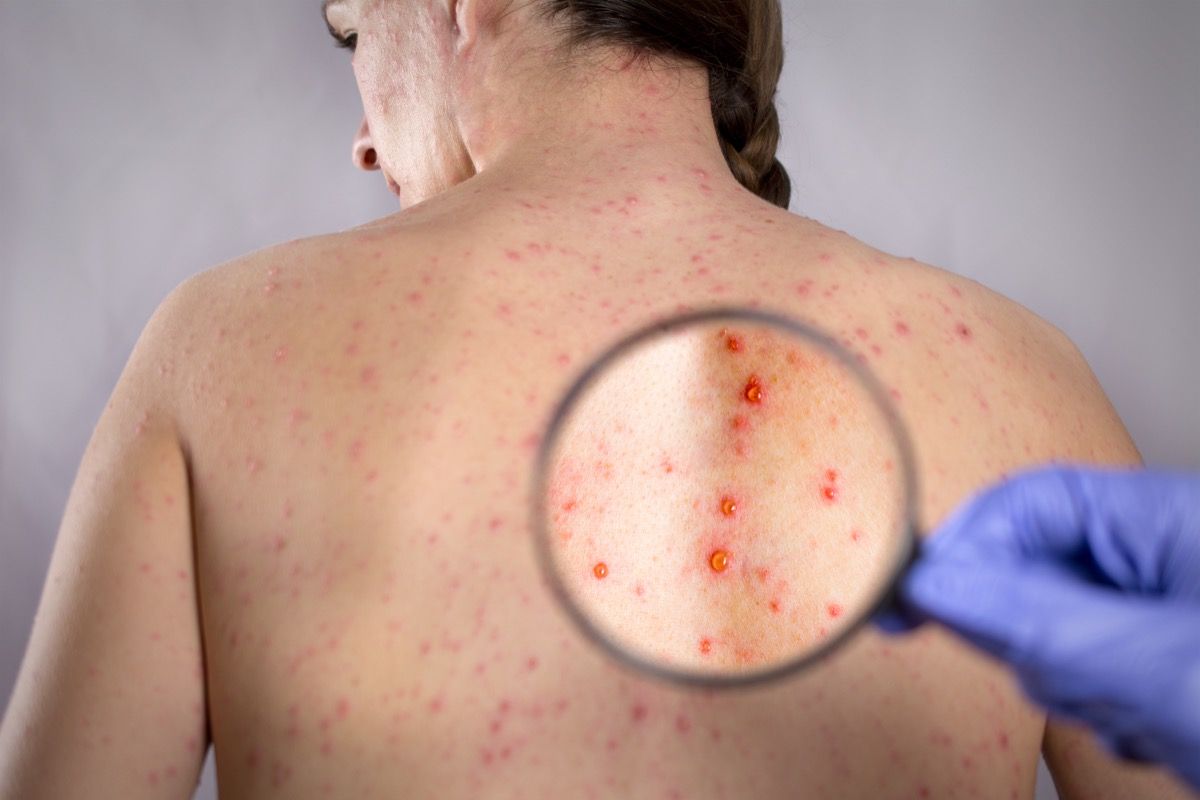 herpes o varicella