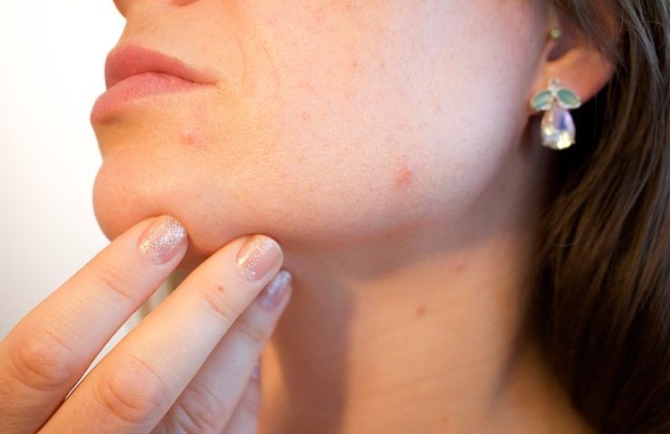 Acne da mascherina, come combatterlo con alcune semplici mosse 