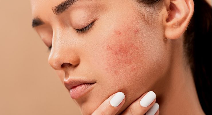 acne sul viso