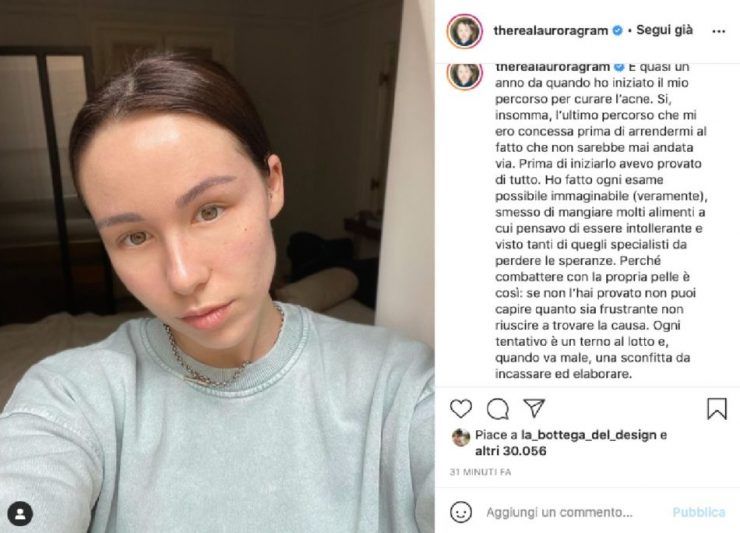 aurora ramazzotti battaglia acne Aurora Ramazzotti Acne