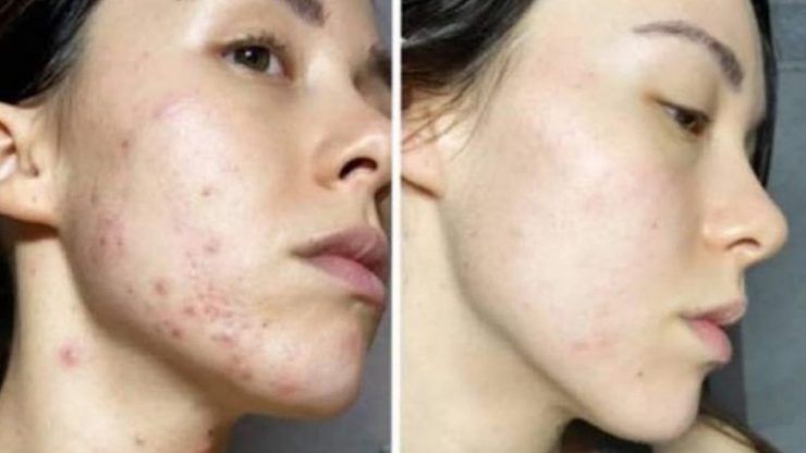 brufoli aurora ramazzotti Aurora Ramazzotti Acne