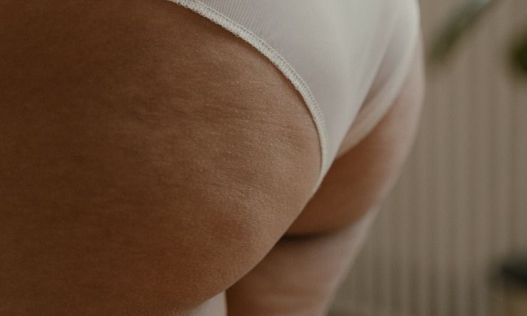 cellulite edematosa