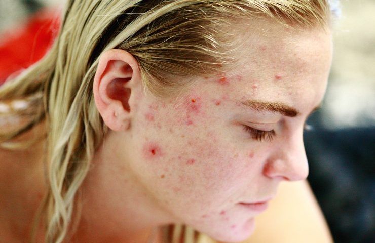 acne-prevenzione