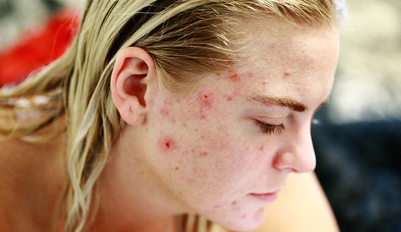 acne-prevenzione