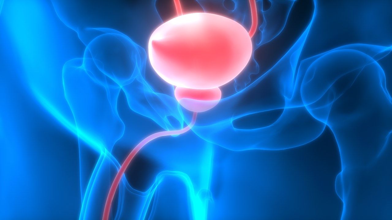 Tumore prostata sviluppi