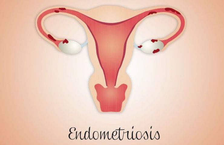 endometriosi cibi indicati