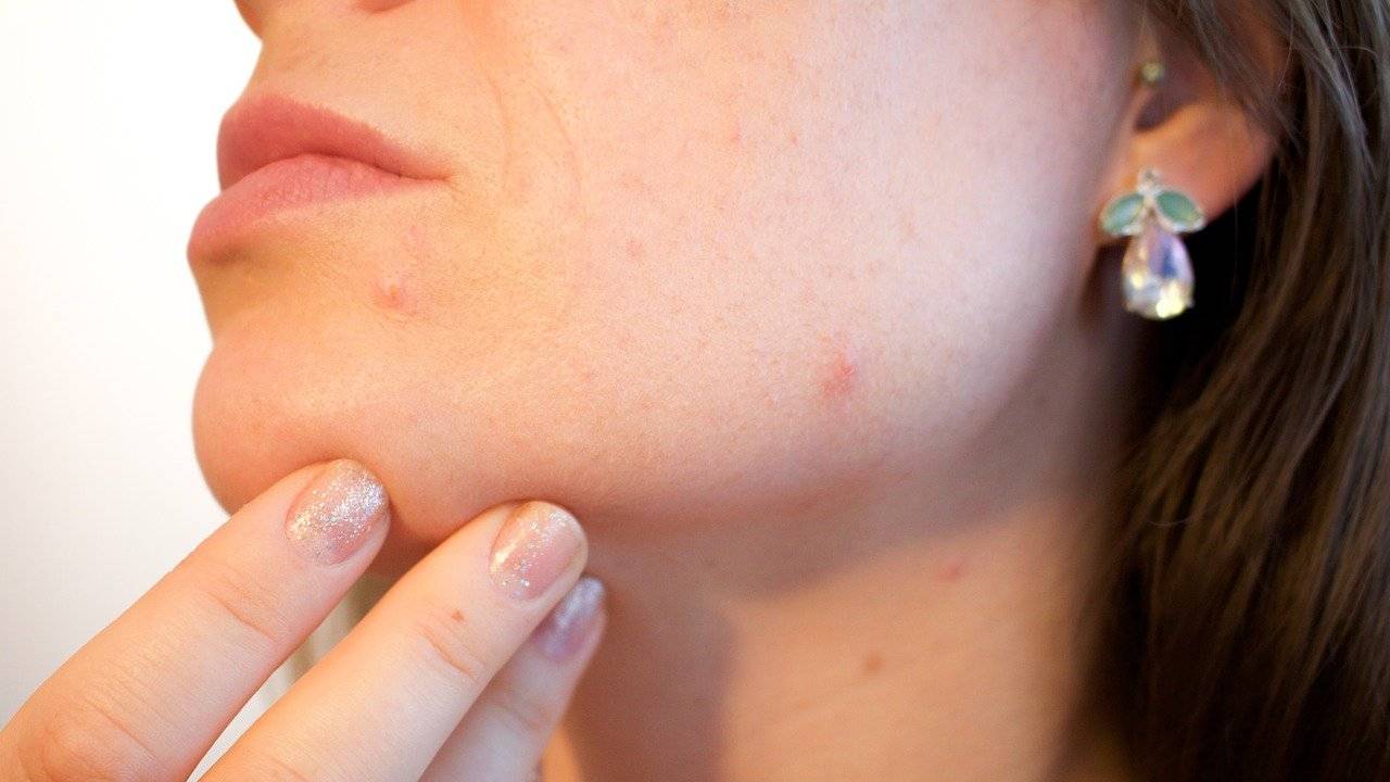 maschera naturale acne