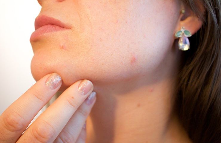 Segni di acne, occorre una maschera naturale