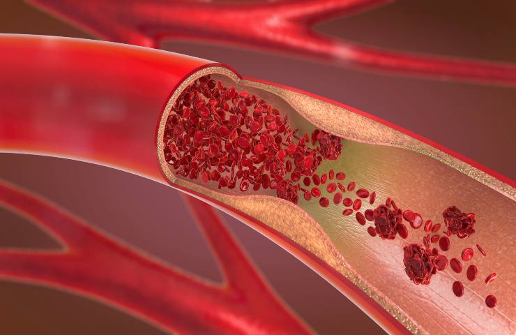 Arterie pulite 