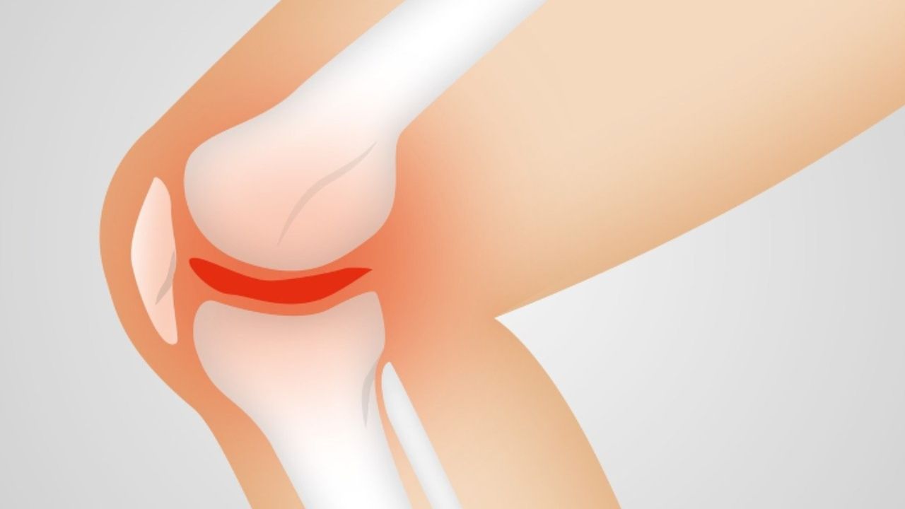 artrosi ginocchio