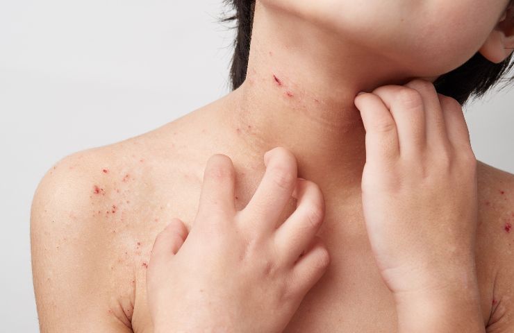 La migliore crema per eczema