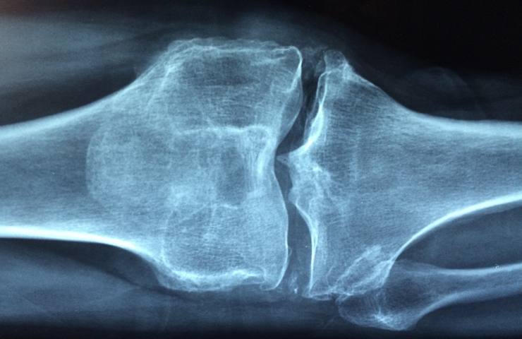 Radiografia all'osso