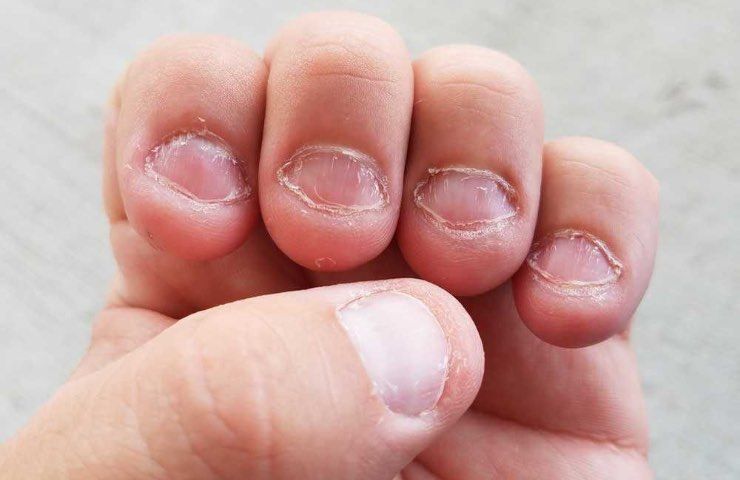 ragioni mangiare unghie porre fine