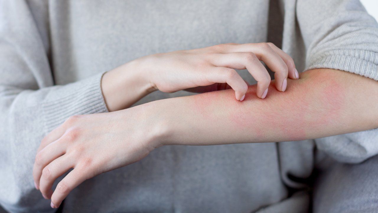 orticaria come alleviare