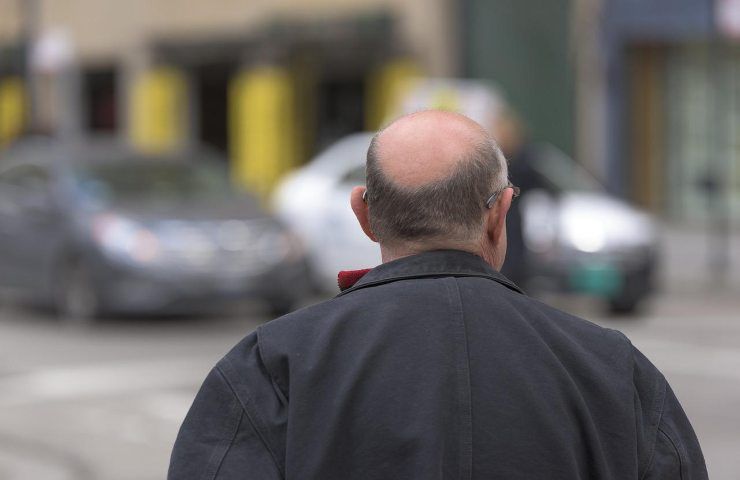 Un uomo affetto da calvizie