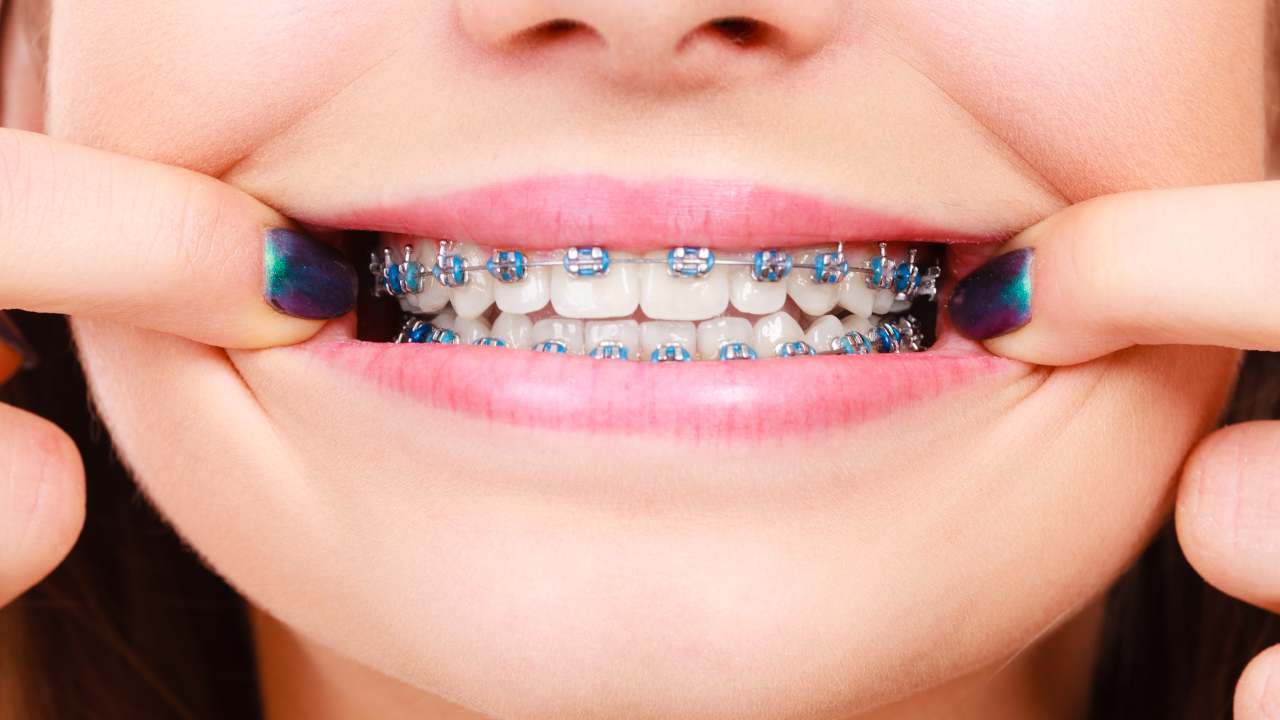 igiene orale denti apparecchio