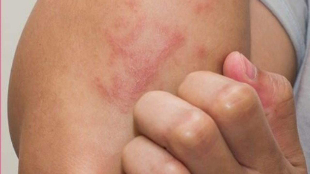 eczema malattia pelle