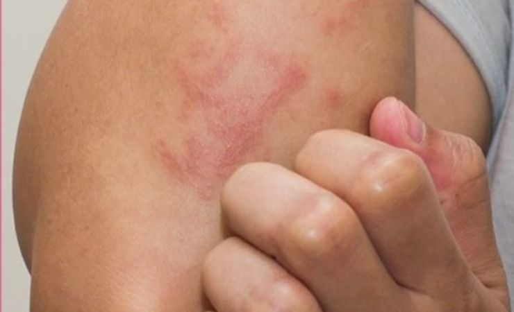 eczema 