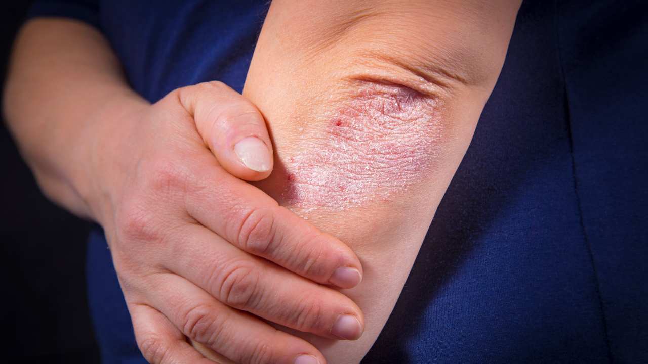 psoriasi caratteristiche trattamenti