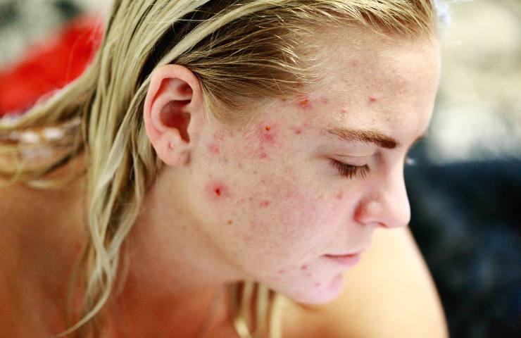 Acne falsi miti