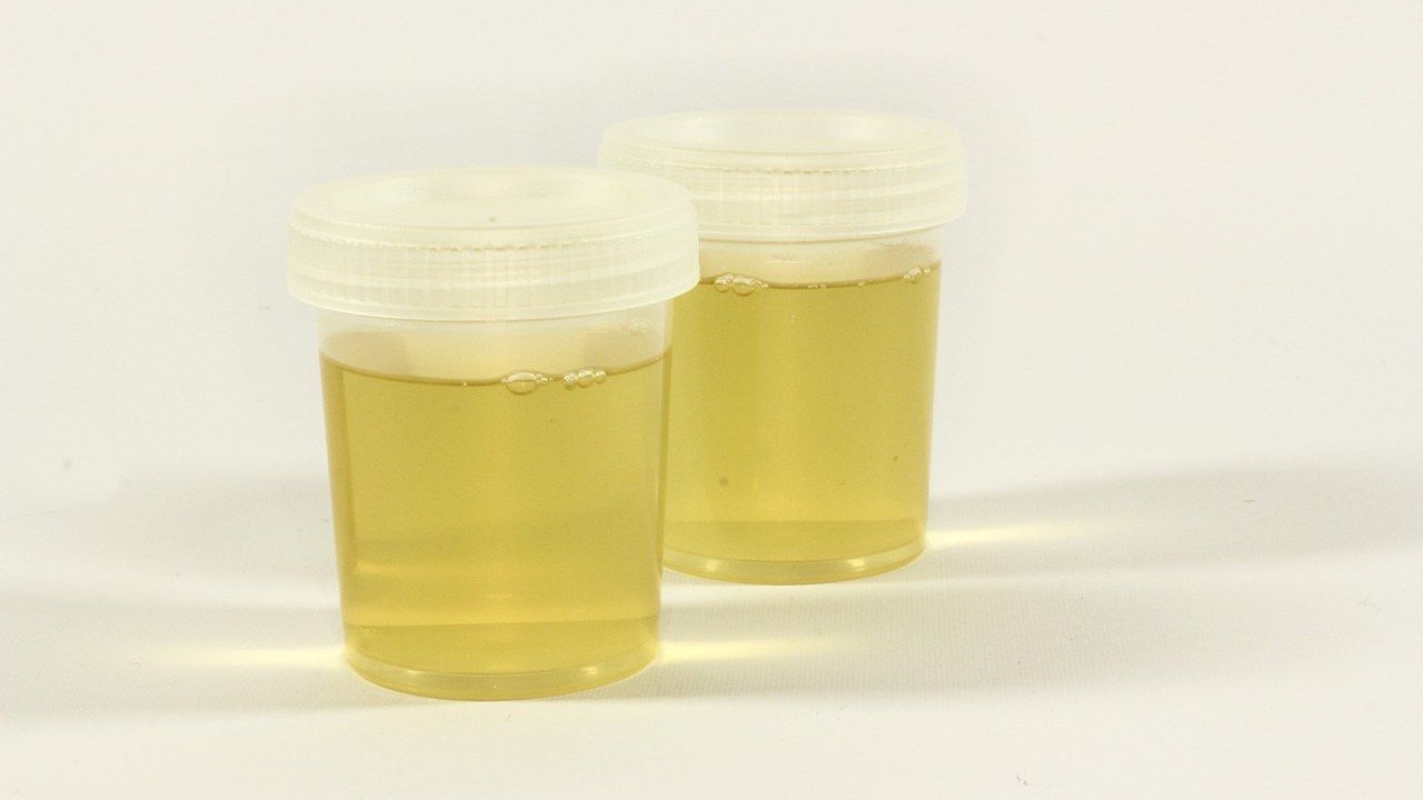 leucociti urine