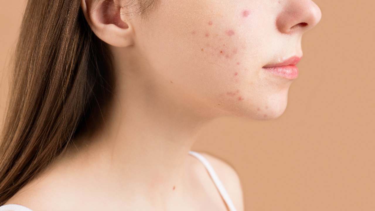 Maschere contro acne