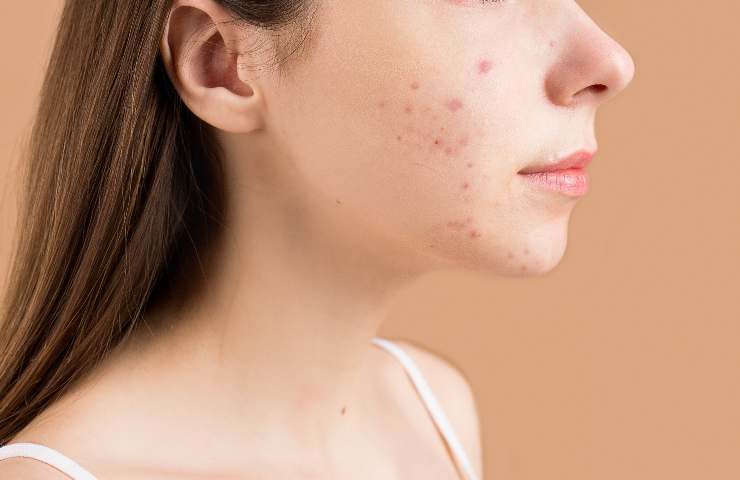 Combattere acne