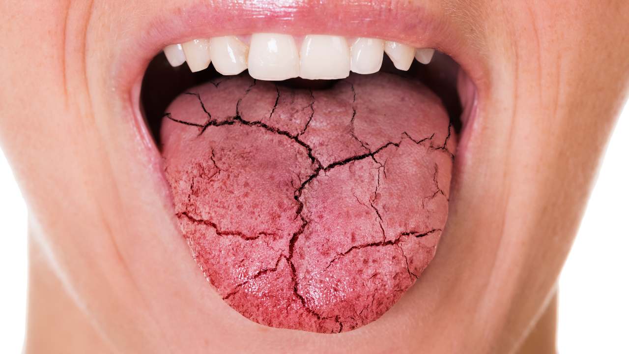 secchezza orale patologie