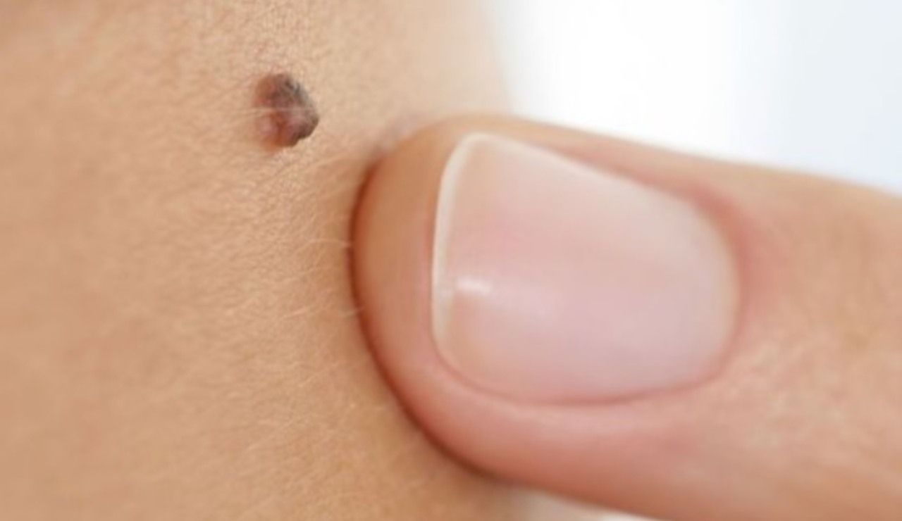 melanoma benigno maligno