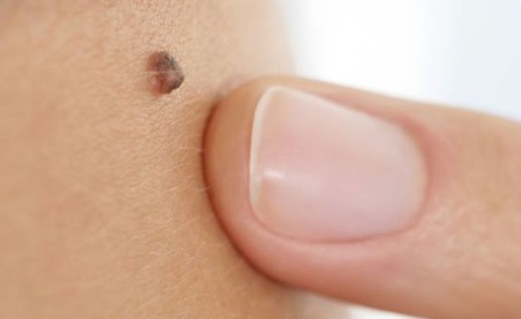 neo melanoma 