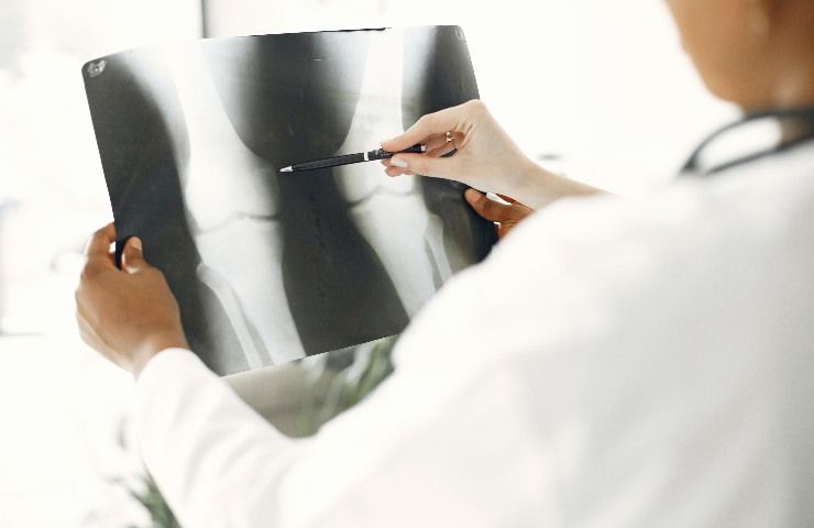 formaggio benefici osteoporosi